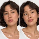 Acne Spot Care